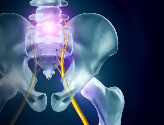 Sciatica: Cause, Prevention and Management